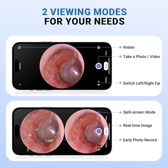 ScopeAround Digital Otoscope Camera w/Built-in Screen, Otoscope with Light Ear Scope for Home Use, Ear Light Otoscope with Camera, Easy Viewing for Everyday Ear Checks, Android/iPhone