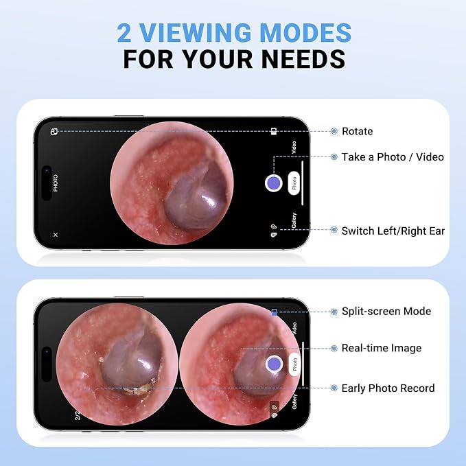 ScopeAround Otoscope with Light, Digital Otoscope w/IPS Screen, 720p HD Ear Wax Removal Tool Camera, Video Otoscope Ear Camera with 6 LED Lights, Compatible with Android/iPhone